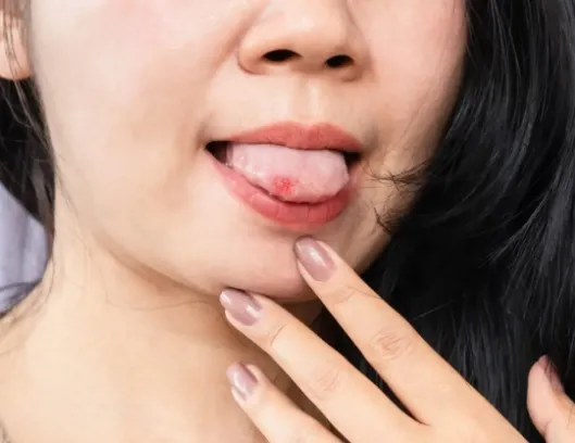 Jak szybko pozbyć się aft w jamie ustnej?