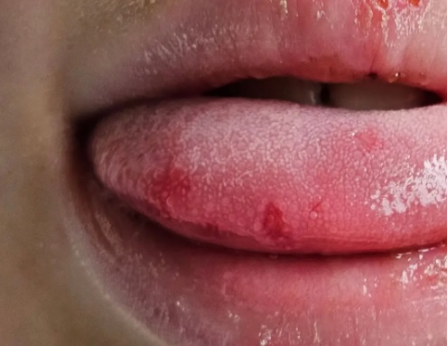 Jakie błędy opóźniają gojenie aft i jak ich unikać?