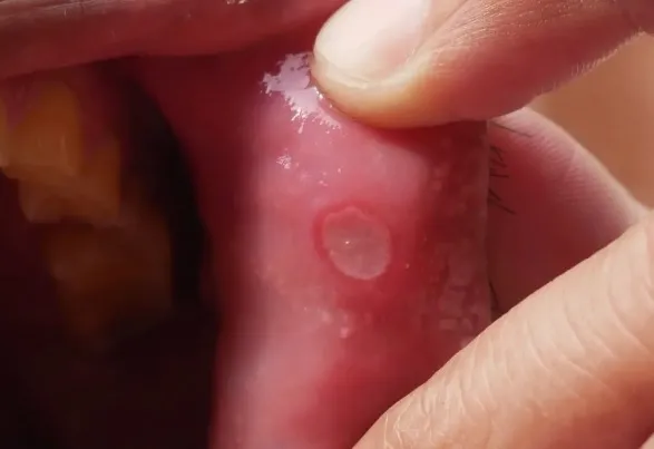 Czy zimne okłady działają na ból i obrzęk związany z aftami?